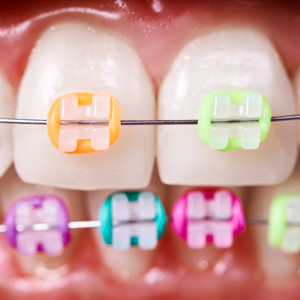 Tipos de ortodoncia infantil Petit Dental